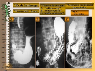 *Rx de Estómago*Rx de Estómago
**Proyección:Proyección:
**Técnica de examen:Técnica de examen:
A-A-
B-B-
C-C-
**Segmento examinado:Segmento examinado:
*M. C.:*M. C.:
sin clínicasin clínica
NMNM
BBAA CC
E ME M
UNTUNT frentefrente
““relleno total”relleno total”
““mucosografía”mucosografía”
““doble contraste”doble contraste”
panorámicapanorámica
 