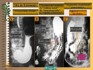 *Rx de Estómago*Rx de Estómago
**Proyección: frenteProyección: frente
**Técnica de examen:Técnica de examen:
A-“relleno total”A-“relleno total”
B- “mucosografía”B- “mucosografía”
C- “doble contraste”C- “doble contraste”
**Segmento examinado:Segmento examinado:
panorámicapanorámica
*M. C.:*M. C.:
sin clínicasin clínica
NMNM
BBAA CC
E ME M
UNTUNT
pacientepaciente
de piede pie
pacientepaciente
enen
decúbitodecúbito
dorsaldorsal
plieguespliegues
gástricosgástricos
áreasáreas
gástricasgástricas
volvervolver
 