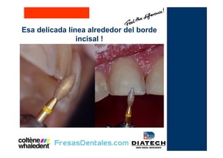 Esa delicada línea alrededor del borde
incisal !
 