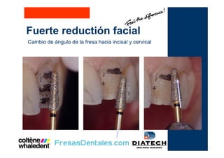 Fuerte reductión facial
Cambio de ángulo de la fresa hacia incisal y cervical
 