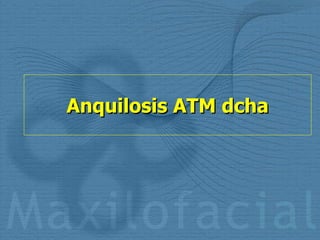 Anquilosis ATM dcha 