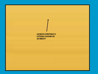 GANCHO CONTINUO O ESTABILIZADOR DE KENNEDY