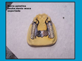 Barra palatina ancha.dento muco soportada