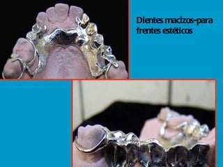 Dientes macizos-para frentes estéticos