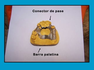 Barra palatina Conector de pase