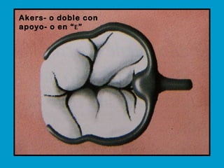 Akers- o doble con apoyo- o en “ E ”