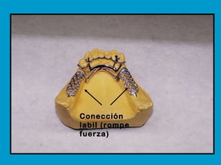 Conección labil (rompe fuerza)