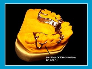 MEDIO JACKSON EN FORMA DE ROACH