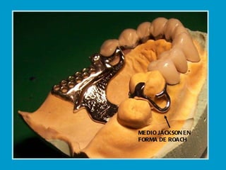 MEDIO JACKSON EN FORMA DE ROACH