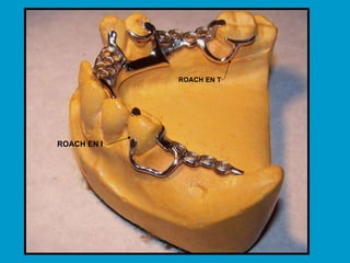 ROACH EN I ROACH EN T