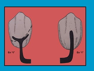 En “t” En “i”