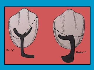 En “y” Media “t”