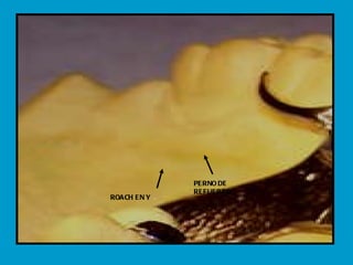 ROACH EN Y PERNO DE REFUERZO