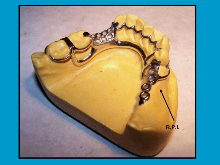 Diseños De Retenedores Como Corsé