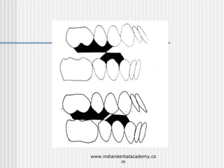 Mode of action of functional appliances /certified fixed orthodontic courses by Indian dental academy  Slide 39