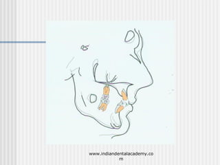 Mode of action of functional appliances /certified fixed orthodontic courses by Indian dental academy  Slide 48