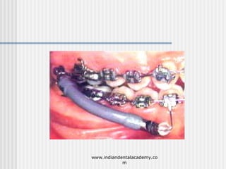 Mode of action of functional appliances /certified fixed orthodontic courses by Indian dental academy  Slide 52