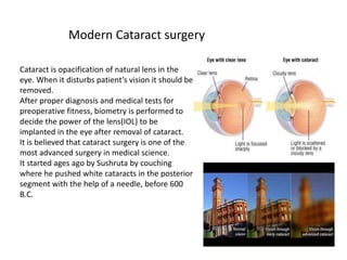 Cataract is opacification of natural lens in the
eye. When it disturbs patient’s vision it should be
removed.
After proper diagnosis and medical tests for
preoperative fitness, biometry is performed to
decide the power of the lens(IOL) to be
implanted in the eye after removal of cataract.
It is believed that cataract surgery is one of the
most advanced surgery in medical science.
It started ages ago by Sushruta by couching
where he pushed white cataracts in the posterior
segment with the help of a needle, before 600
B.C.
Modern Cataract surgery
 