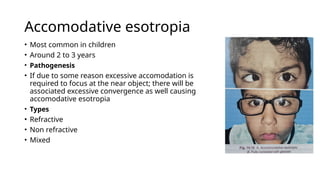 comitant strabismus and history of treatment.pptx