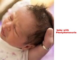baby with
Phenylketonuria
 