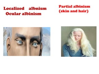 Localized albnism
Ocular albinism
Partial albinism
(skin and hair)
 