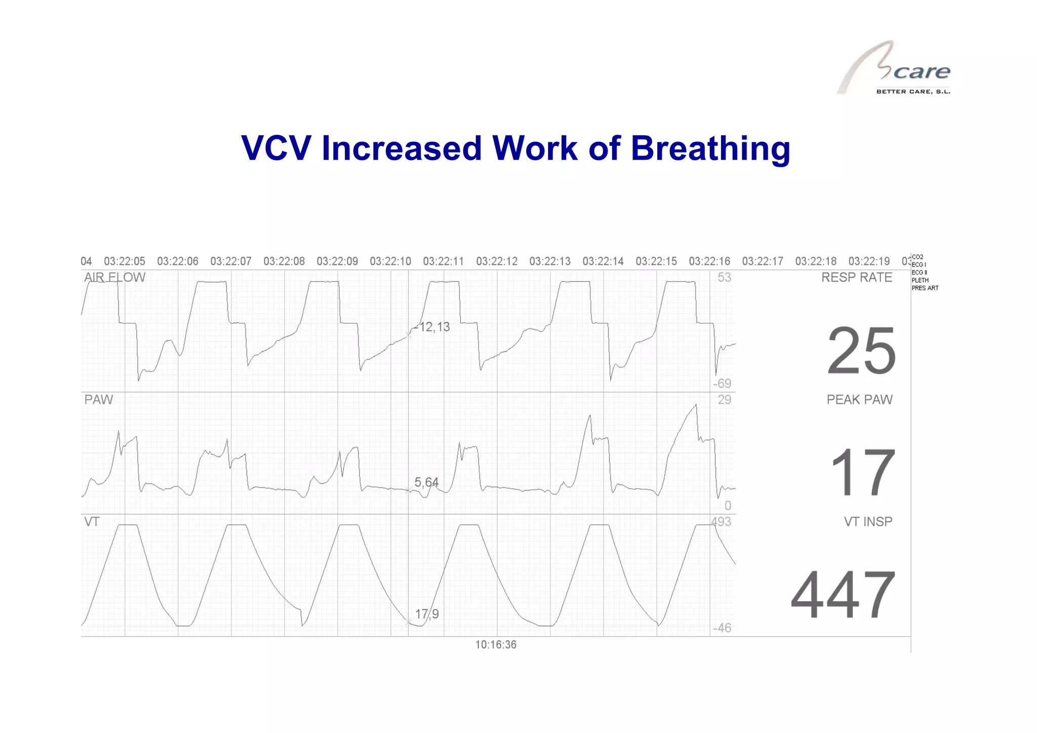 VCV Increased Work of Breathing

 
