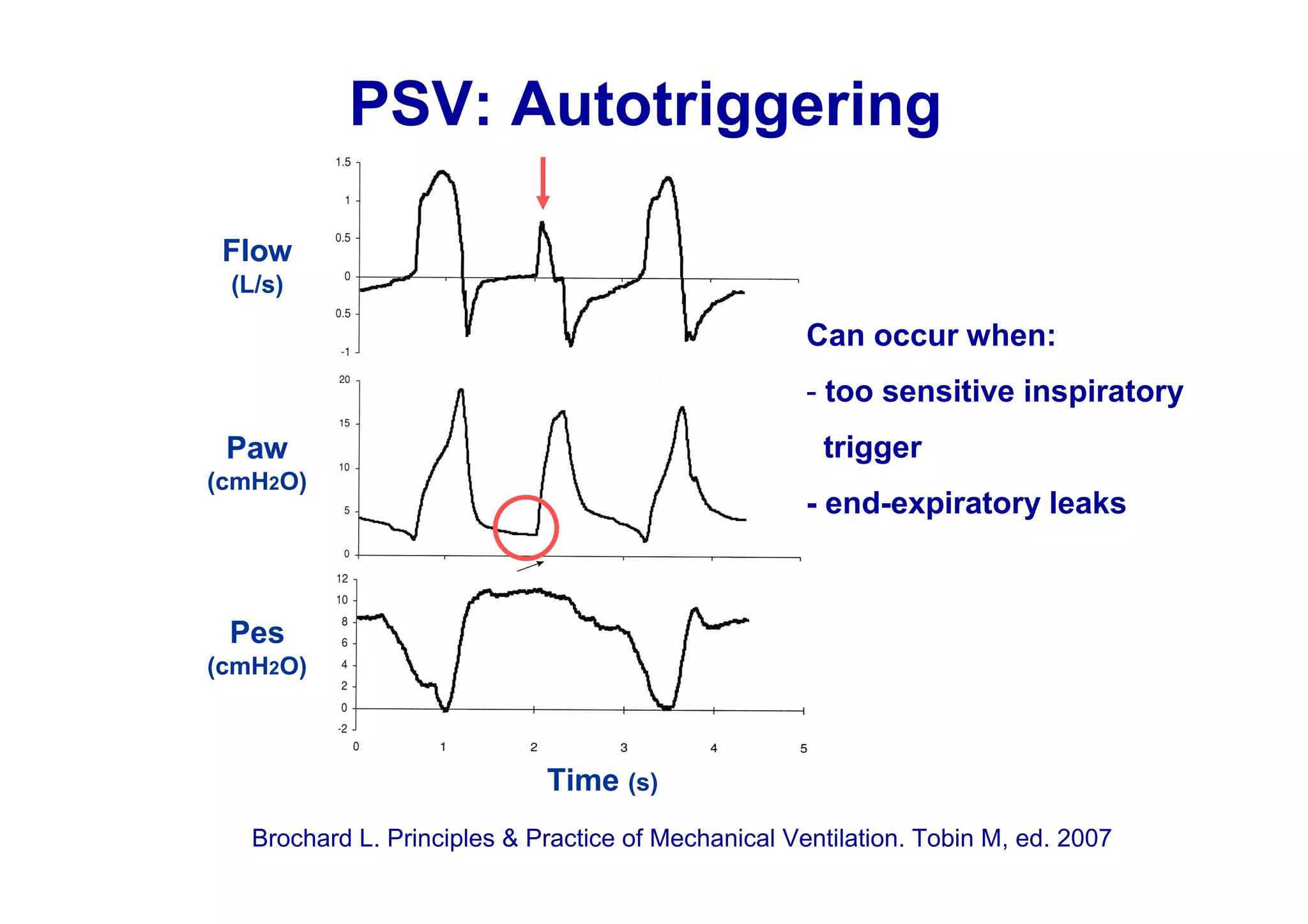 PSV: Autotriggering
Flow
(L/s)

Can occur when:
- too sensitive inspiratory
trigger

Paw
(cmH2O)

- end-expiratory leaks

Pes
(cmH2O)

Time (s)
Brochard L. Principles & Practice of Mechanical Ventilation. Tobin M, ed. 2007

 
