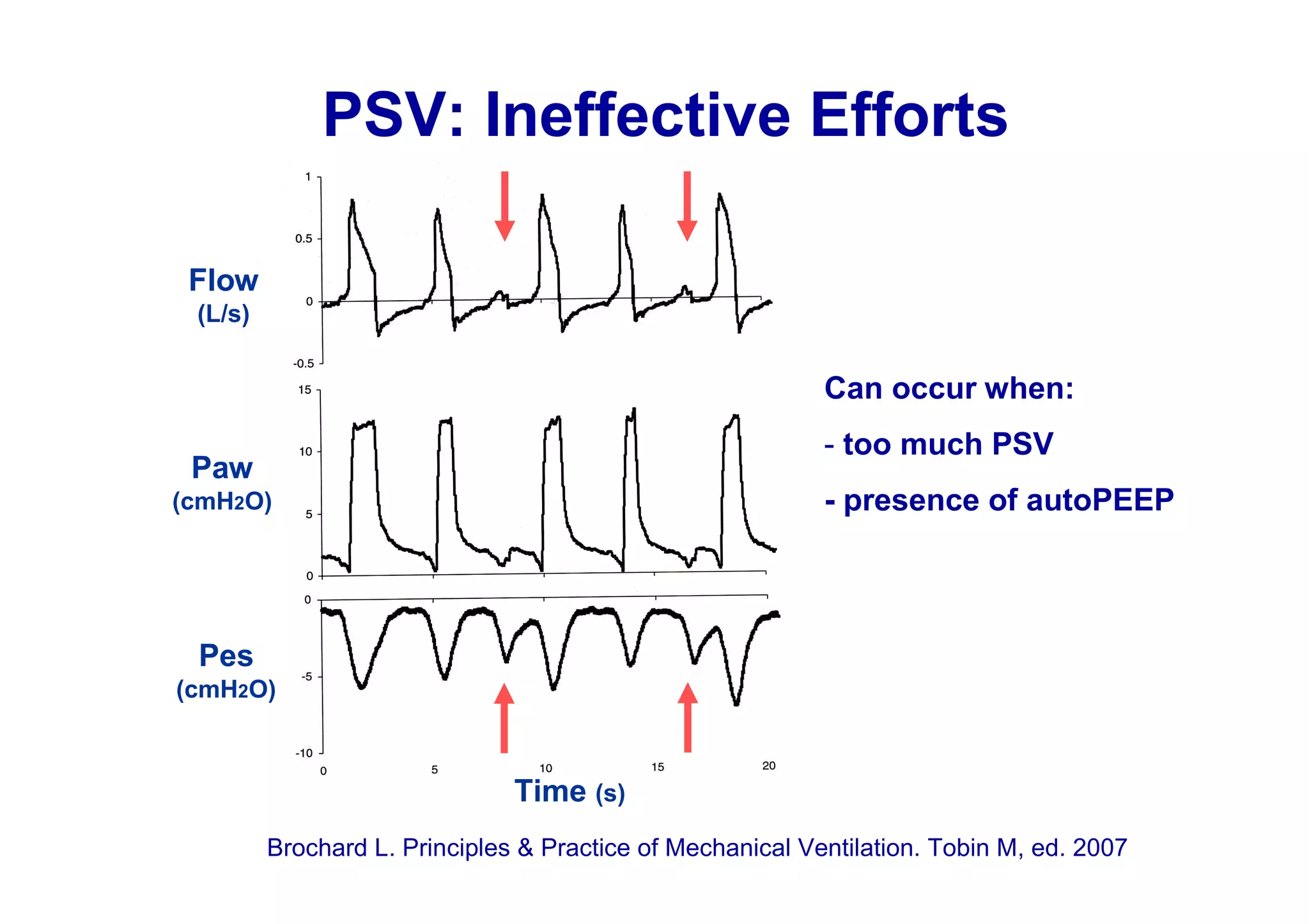 PSV: Ineffective Efforts
Flow
(L/s)

Can occur when:
- too much PSV

Paw

- presence of autoPEEP

(cmH2O)

Pes
(cmH2O)

Time (s)
Brochard L. Principles & Practice of Mechanical Ventilation. Tobin M, ed. 2007

 