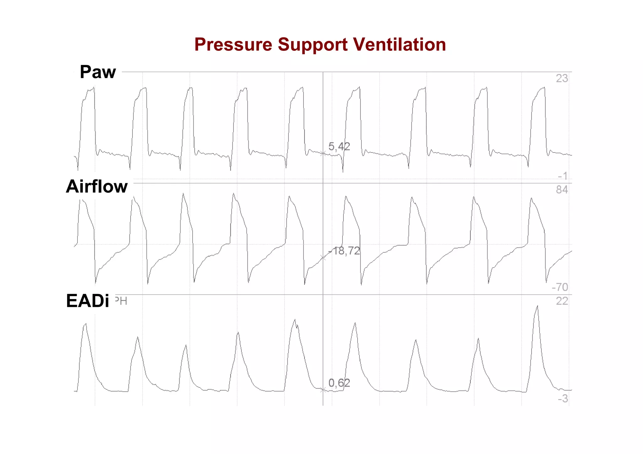Pressure Support Ventilation
Paw

Airflow

EADi

 
