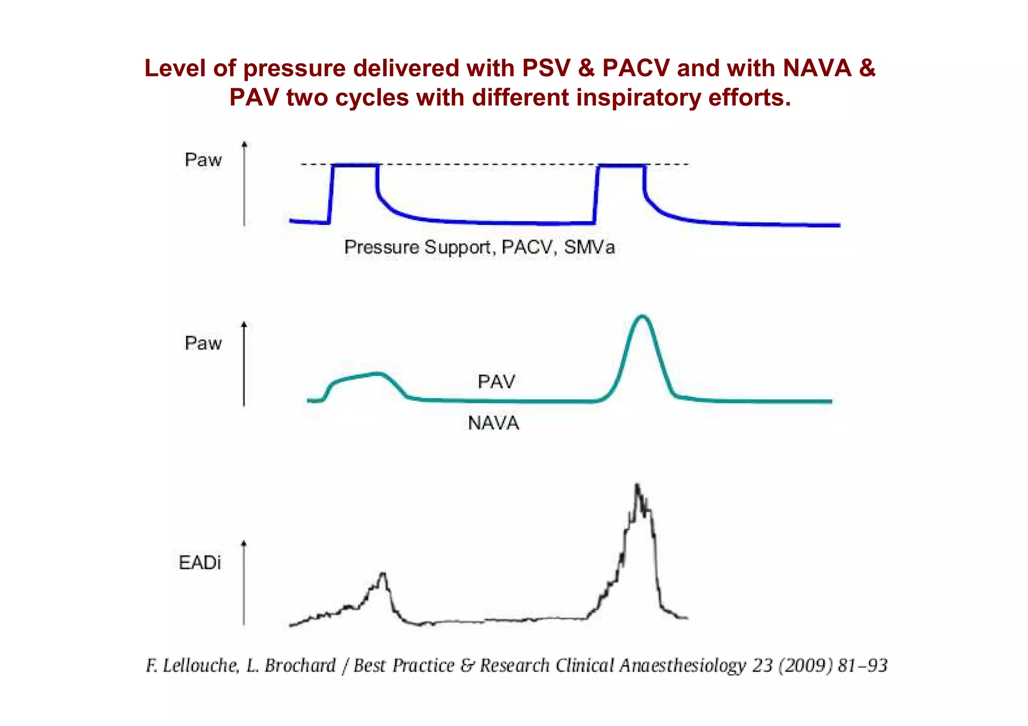 Level of pressure delivered with PSV & PACV and with NAVA &
PAV two cycles with different inspiratory efforts.

 