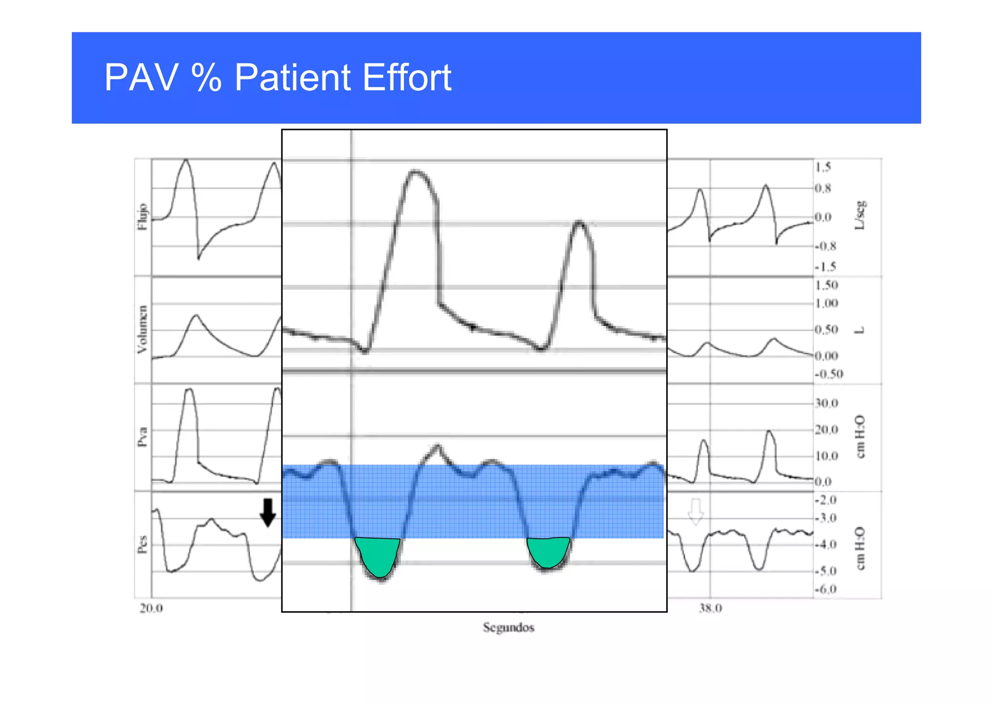 PAV % Patient Effort

 