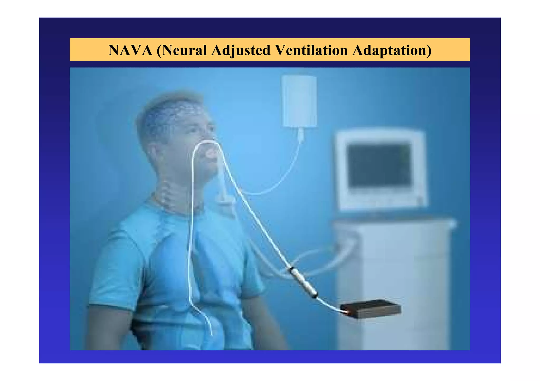 NAVA (Neural Adjusted Ventilation Adaptation)

 