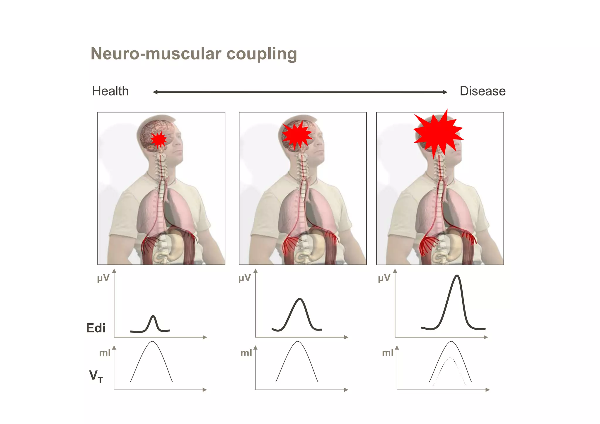 Neuro-muscular coupling
Health

µV

Disease

µV

µV

Edi
ml

VT

ml

ml

 