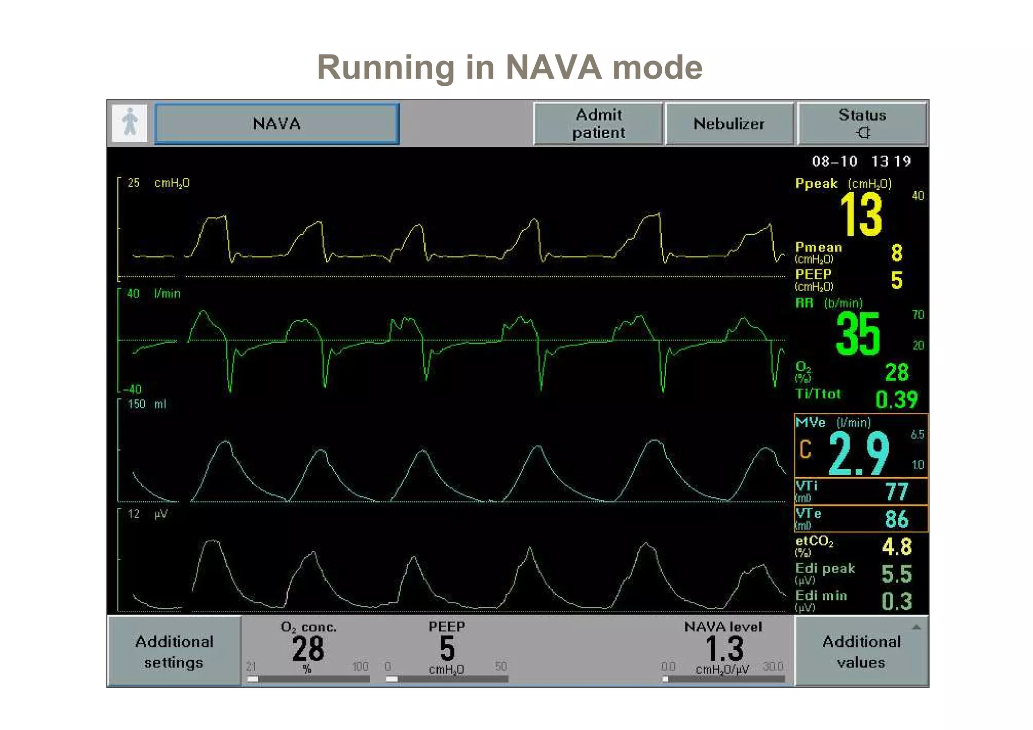 Running in NAVA mode

 