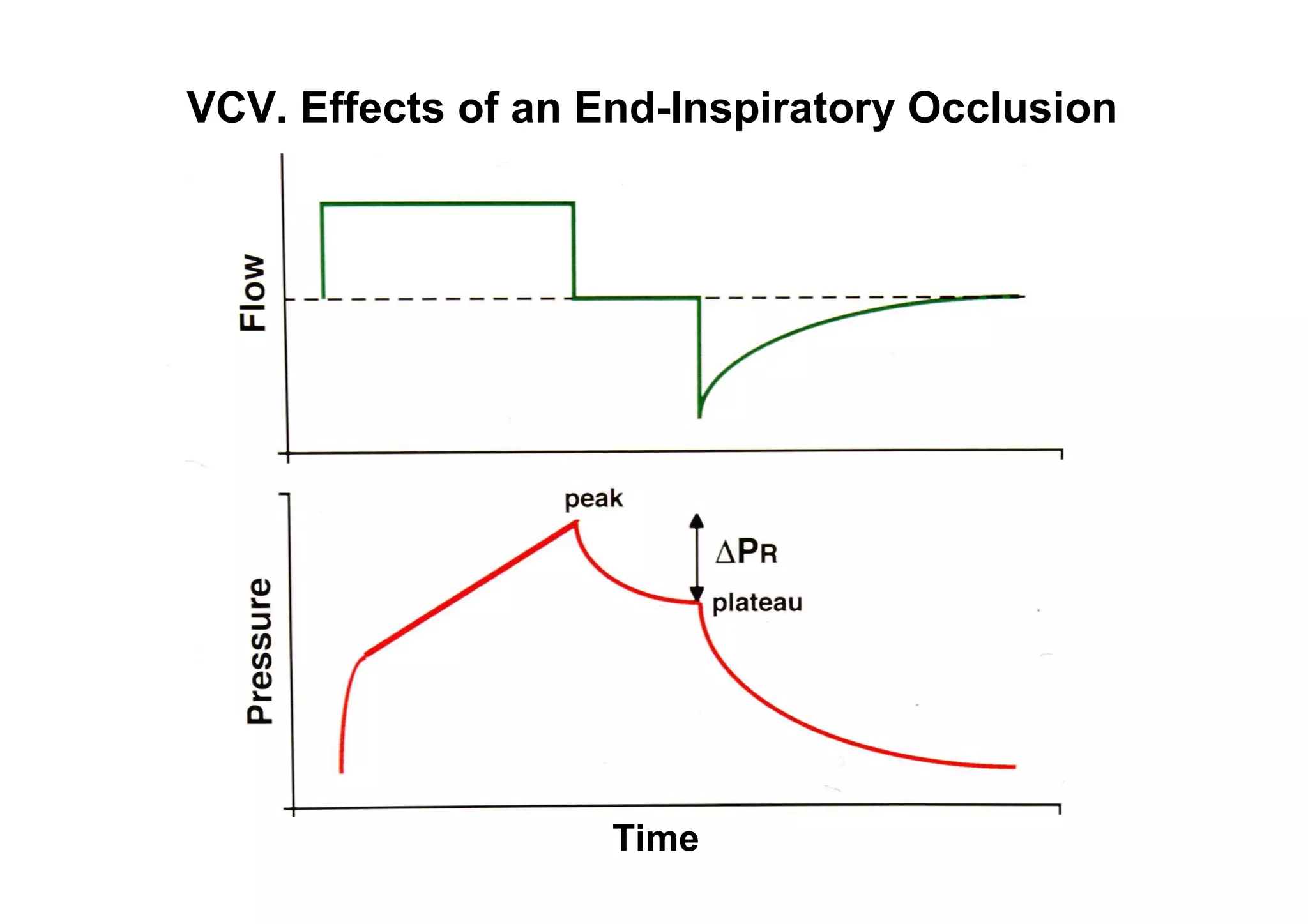VCV. Effects of an End-Inspiratory Occlusion

Time

 