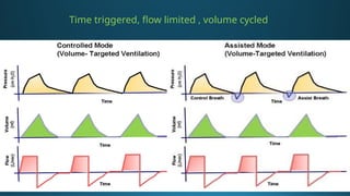 Vent Mode Algorithm modes of ventilation(Anesthesia) - .pptx