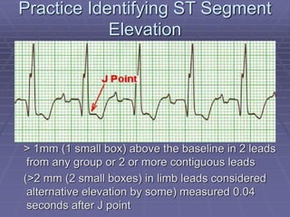 mod_i-12_lead_ekgs.ppt