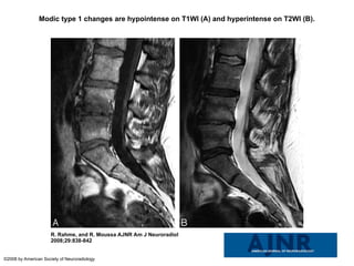 Modic changes on degenerative disc spine.ppt