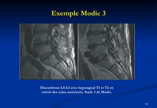 Exemple Modic 3 Discarthrose L4-L5 avec hyposignal T1 et T2 en miroir des coins antérieurs. Stade 3 de Modic. 