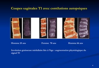 Coupes sagittales T1 avec corrélations autopsiques  Homme 25 ans  Femme  70 ans  Homme 66 ans Involution graisseuse médullaire liée à l’âge : augmentation physiologique du signal T1 