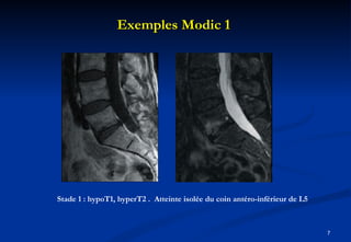 Exemples Modic 1  Stade 1 : hypoT1, hyperT2 .  Atteinte isolée du coin antéro-inférieur de L5 