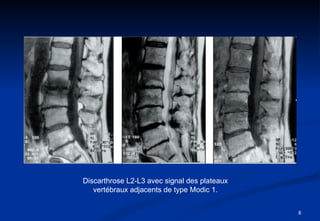 Discarthrose L2-L3 avec signal des plateaux vertébraux adjacents de type Modic 1. 