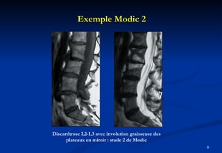 Exemple Modic 2 Discarthrose L2-L3 avec involution graisseuse des plateaux en miroir : stade 2 de Modic 