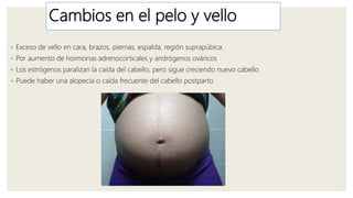 Cambios en el pelo y vello
◦ Exceso de vello en cara, brazos, piernas, espalda, región suprapúbica.
◦ Por aumento de hormonas adrenocorticales y andrógenos ováricos
◦ Los estrógenos paralizan la caída del cabello, pero sigue creciendo nuevo cabello
◦ Puede haber una alopecia o caída frecuente del cabello postparto
 
