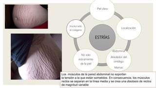 ESTRÍAS
Piel clara
Localización:
Abdominal
Alrededor del
ombligo
Mamas
No solo
estiramiento
de la piel
Involucrado
el colágeno
Los músculos de la pared abdominal no soportan
la tensión a la que están sometidos. En consecuencia, los músculos
rectos se separan en la línea media y se crea una diastasis de rectos
de magnitud variable
 