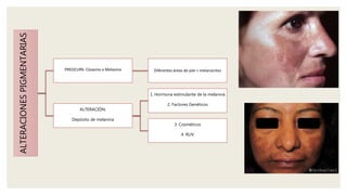 ALTERACIONESPIGMENTARIAS
PREOCUPA: Cloasma o Melasma Diferentes áreas de piel > melanocitos
ALTERACIÓN:
Depósito de melanina
1. Hormona estimulante de la melanina
2. Factores Genéticos
3. Cosméticos
4. RUV
 