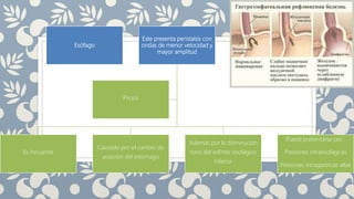 Esófago
Este presenta peristalsis con
ondas de menor velocidad y
mayor amplitud
Es frecuente
Causado por el cambio de
posición del estomago
Además por la disminución
tono del esfínter esofágico
inferior
Puede presentarse por :
Presiones intraesofágicas
Presiones intragastricas altas
Pirosis
 