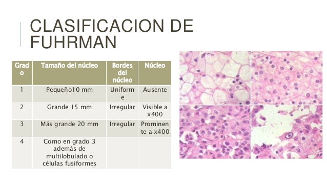 Modificaciones a la clasificacion de gleason y fuhrman