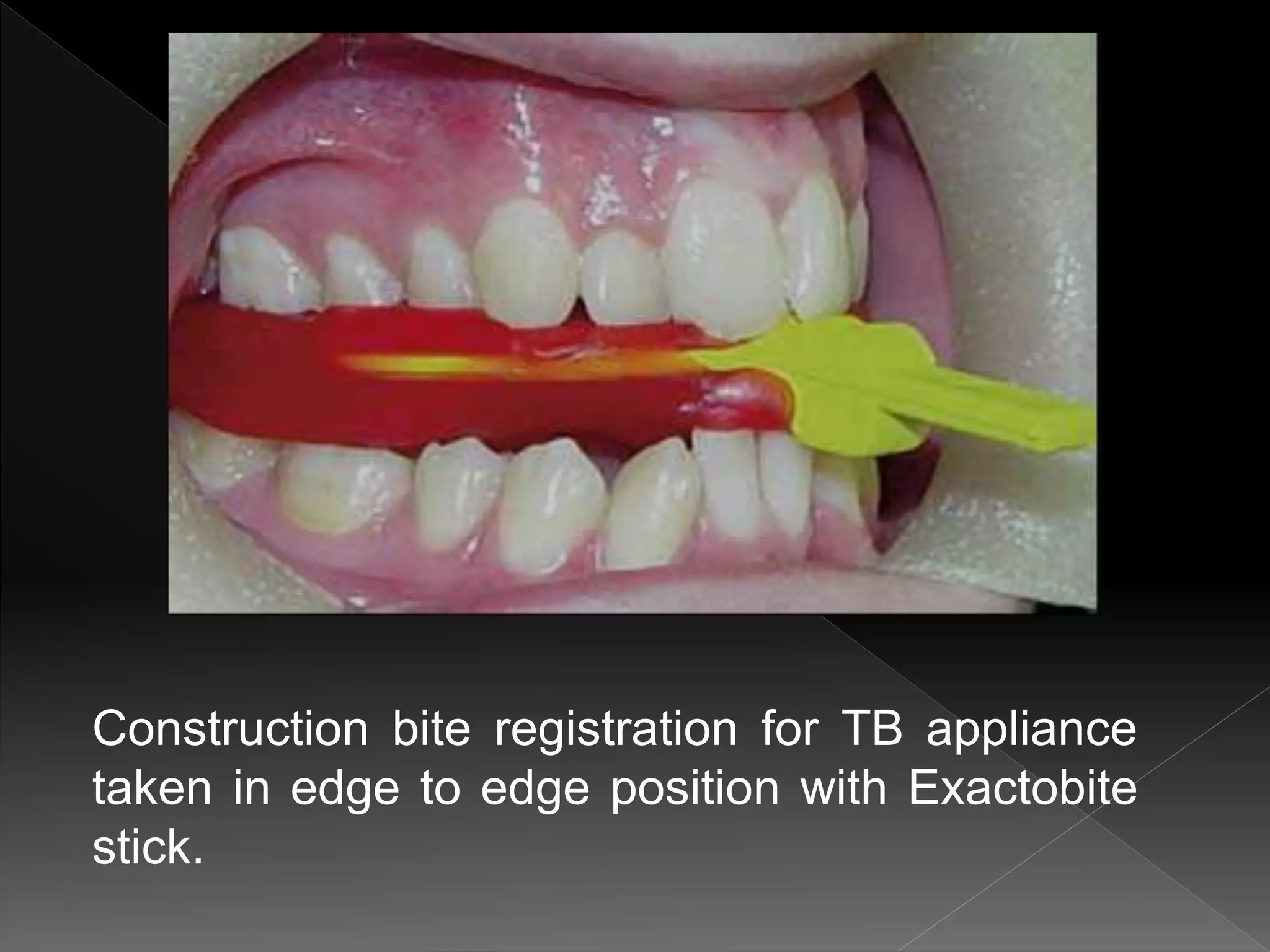 Construction bite registration for TB appliance
taken in edge to edge position with Exactobite
stick.
 