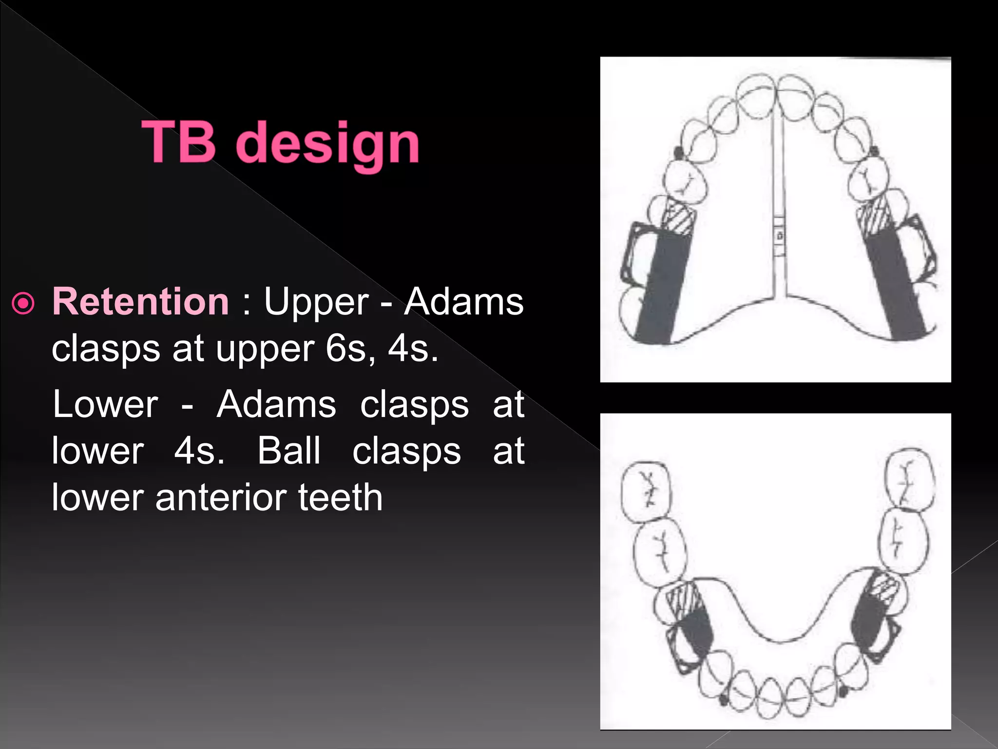  Retention : Upper - Adams
clasps at upper 6s, 4s.
Lower - Adams clasps at
lower 4s. Ball clasps at
lower anterior teeth
 